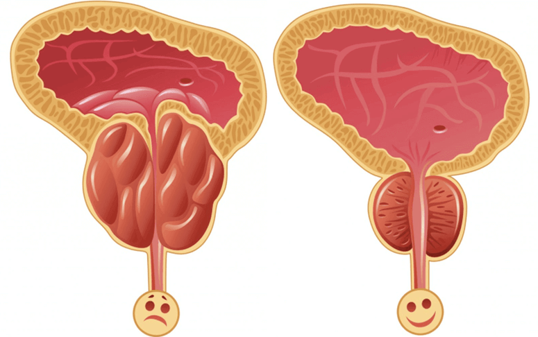 erkaklarda potentsial muammolarning sabablari